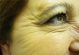  Frown lines after Botulinum Toxin