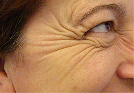  Frown lines before Botulinum Toxin