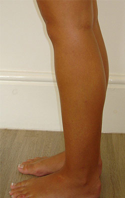  Liposuction Legs – After