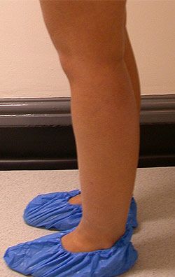  Liposuction Legs – Before
