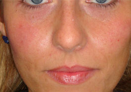  Fillers to replump face – After