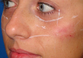  Fillers to replump face – Before