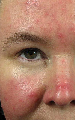  IPL for Rosacea, Before