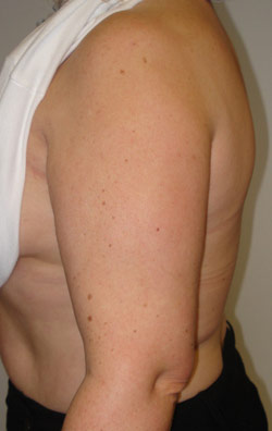  Liposuction Arms – After