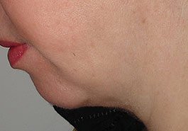  Liposuction Chin – After
