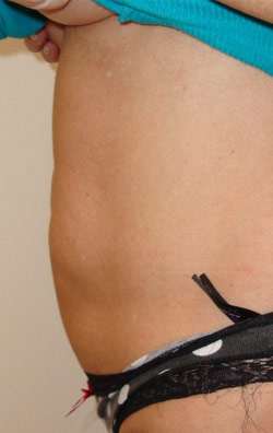  Liposuction stomach – After