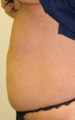  Liposuction stomach – Before