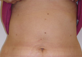  Liposuction stomach – After