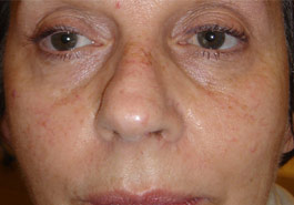  IPL for Rosacea, Before